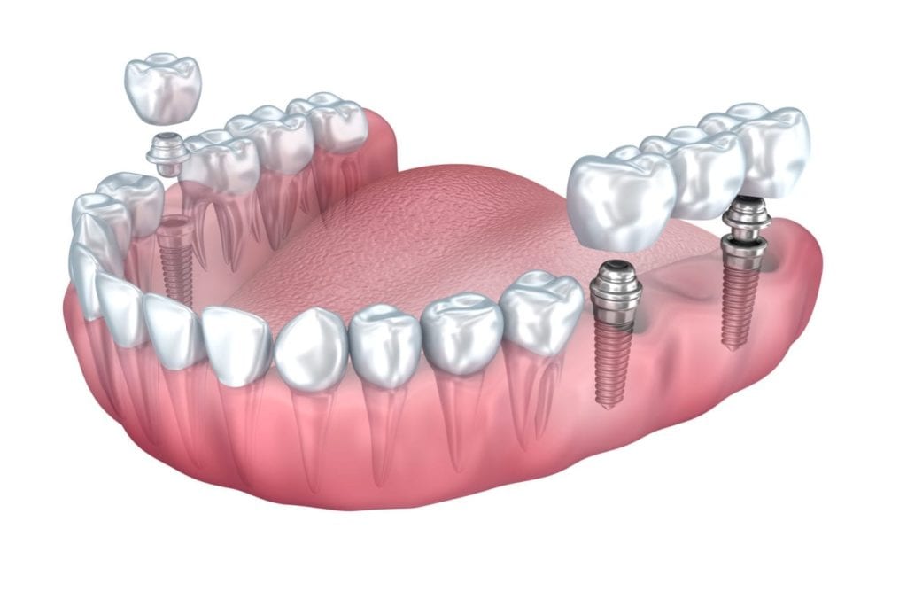 Benefits of Dental Implants Oyster Bay NY