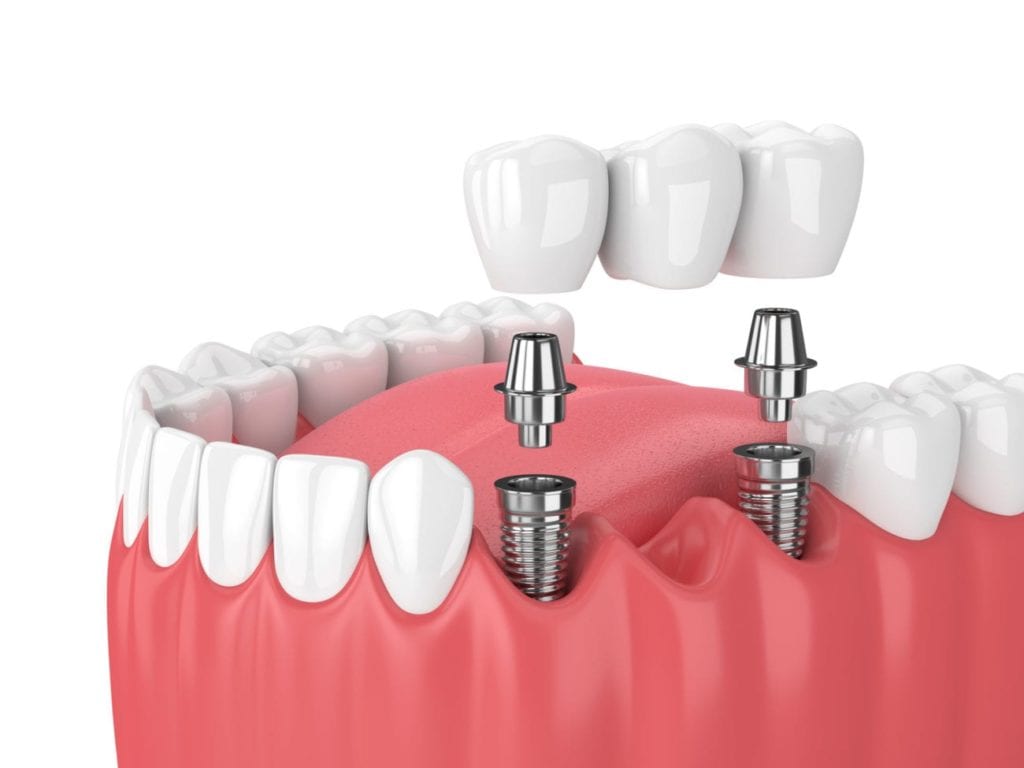 dental implant-supported bridge in Queens New York