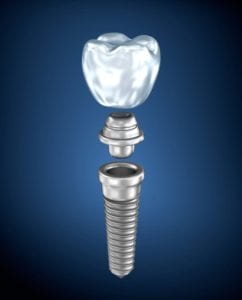 Dental Implants Bayside, New York