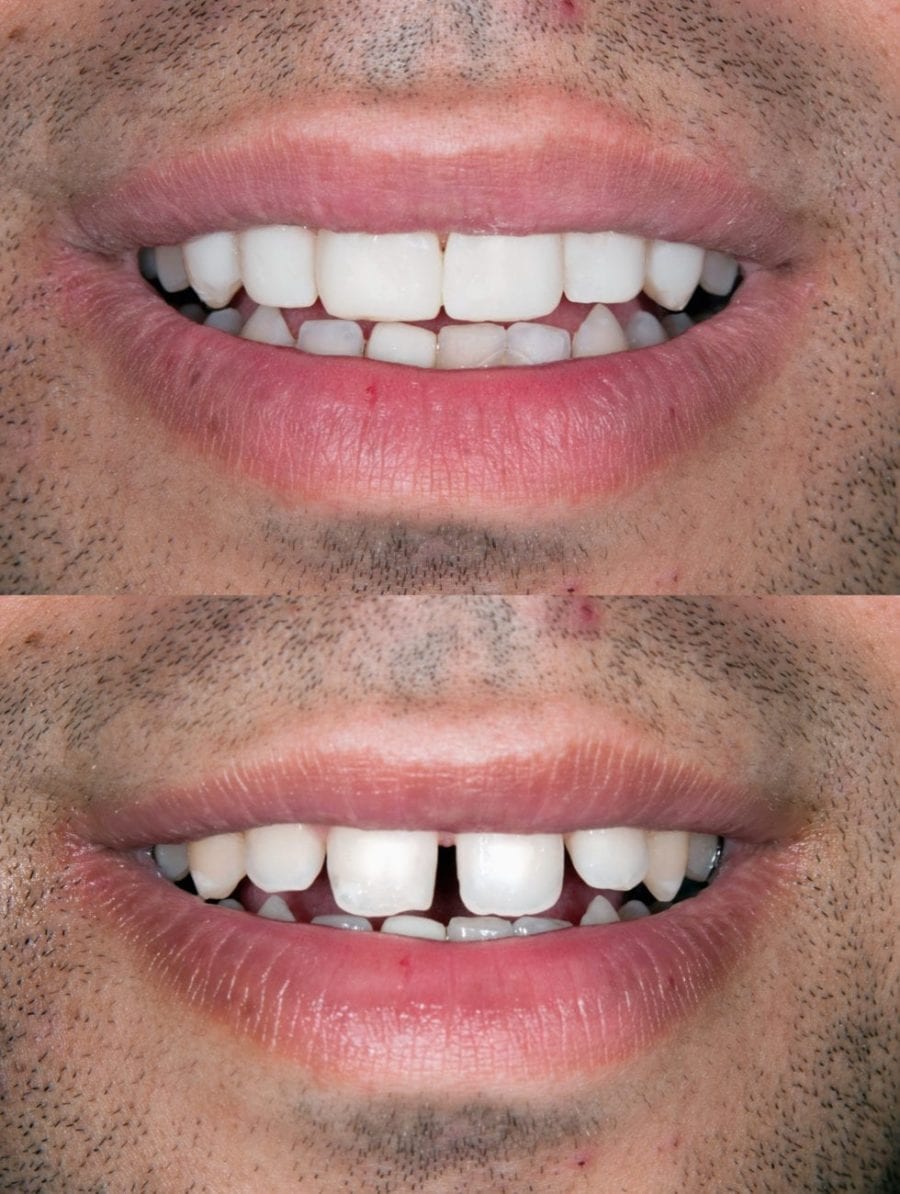 Before and after: crooked teeth