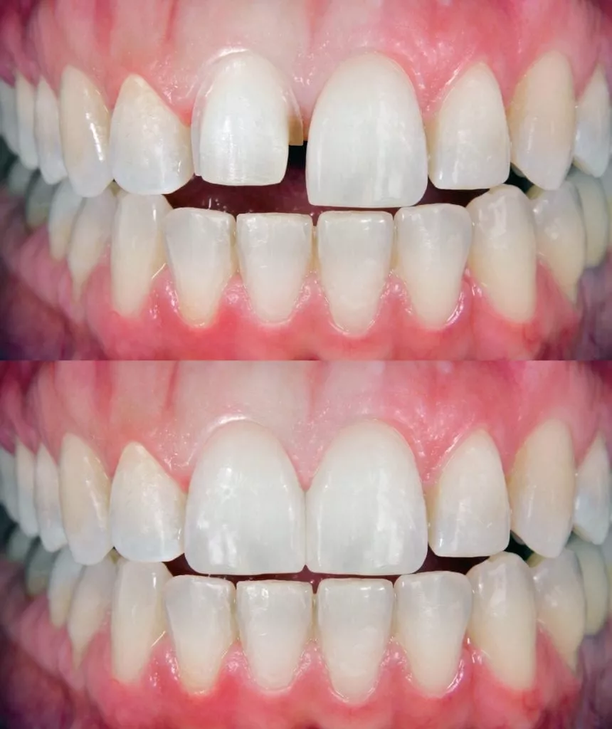 Before and After porcelain veneers in Oyster Bay, NY