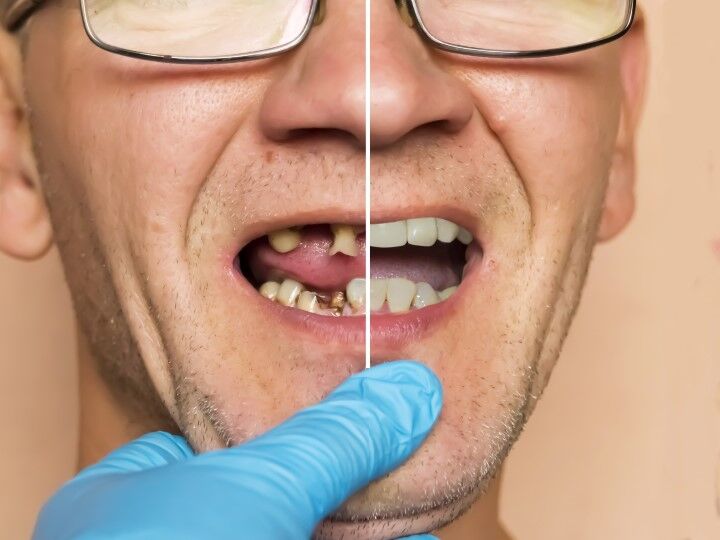 Before & After: Missing Teeth - Corbin Dental