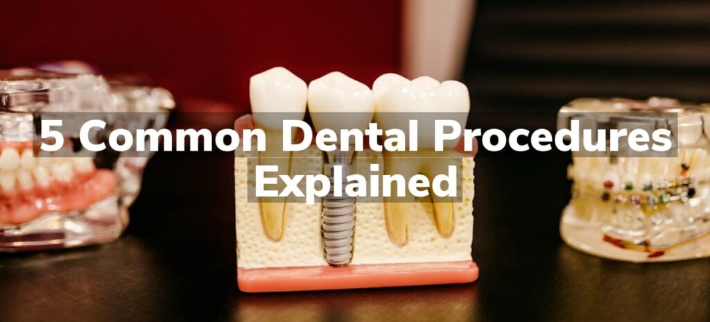 5 Common Dental Procedures Explained | Corbin Dental