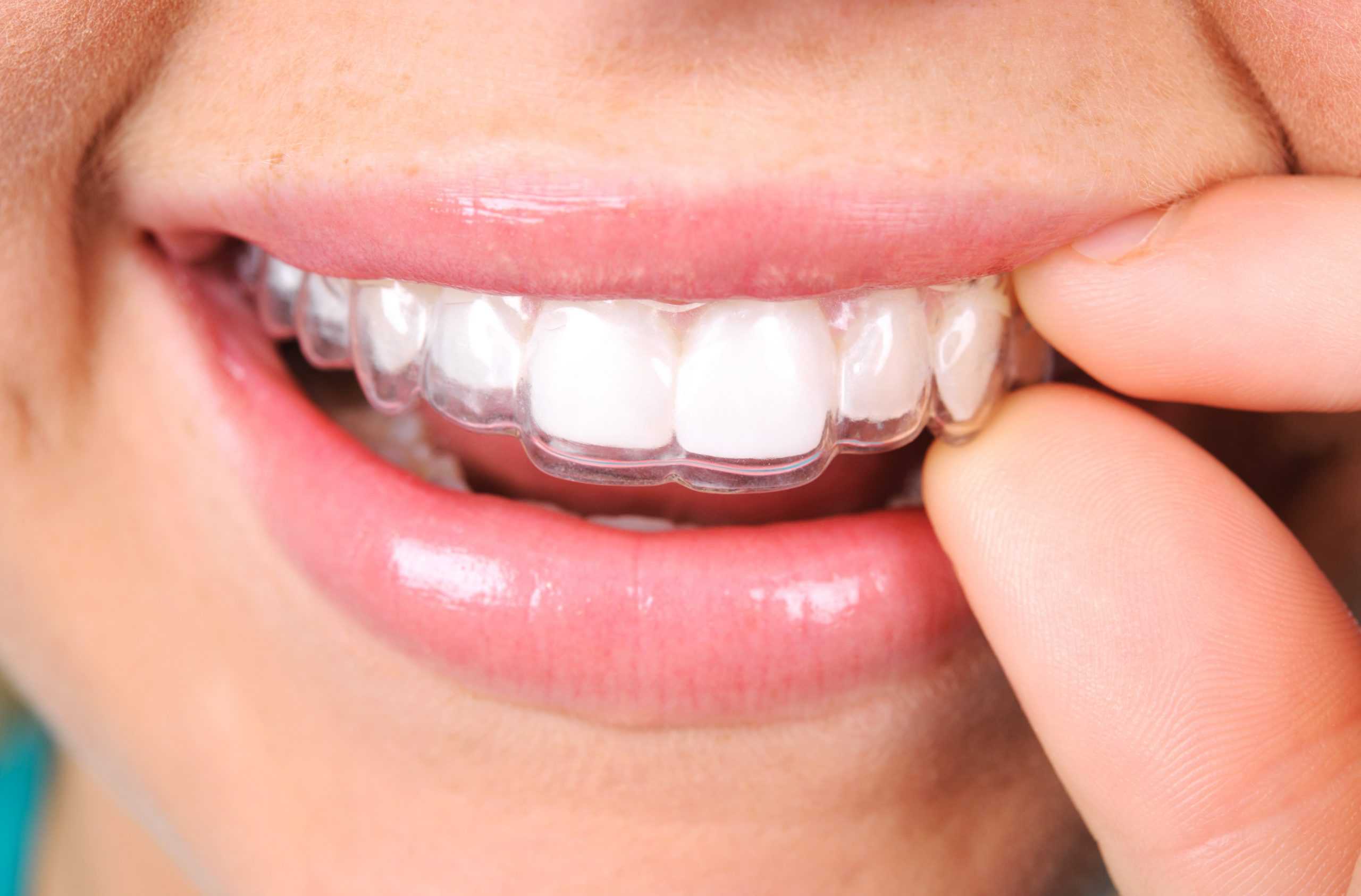 Invisalign clear aligners on a smiling person's teeth