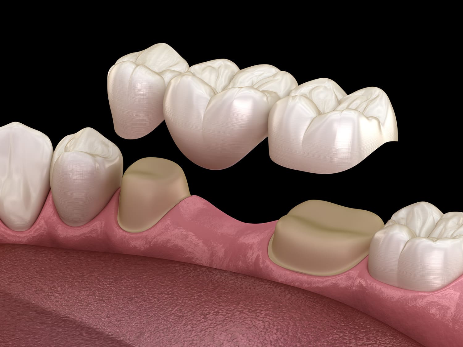 Dental Bridges Placement – Restore Your Smile Dental Bridges Placement