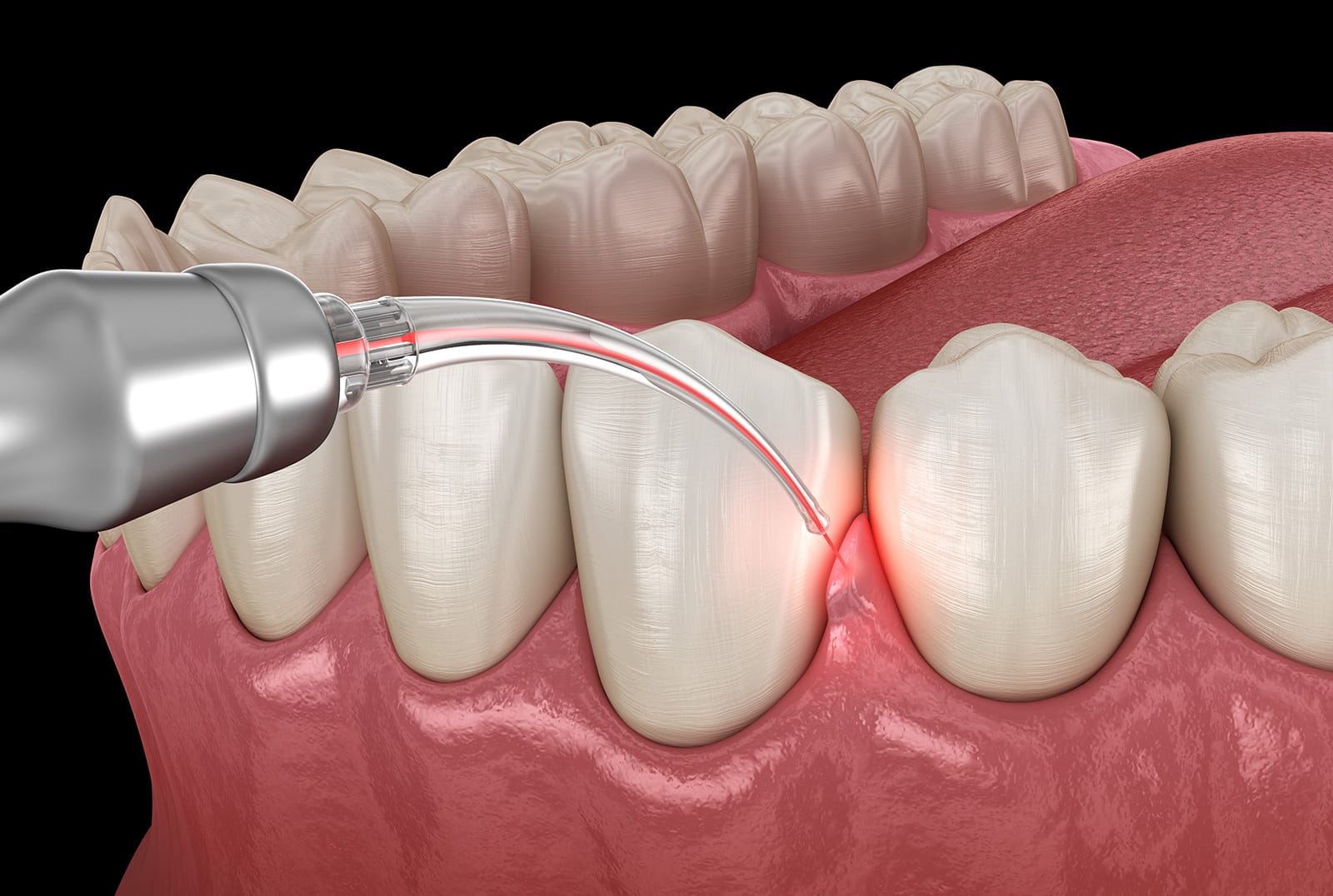 Laser Dentistry Treatment – Corbin Dental Laser dentistry treatment at Corbin Dental.