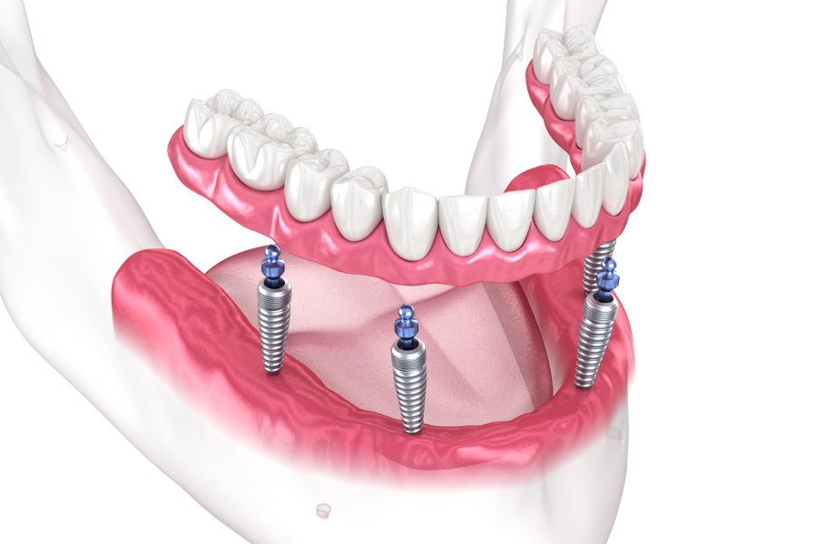 What Are the Benefits of All-On-Four Implants?