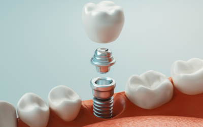 The Benefits of Dental Implants: Why They’re Worth Considering