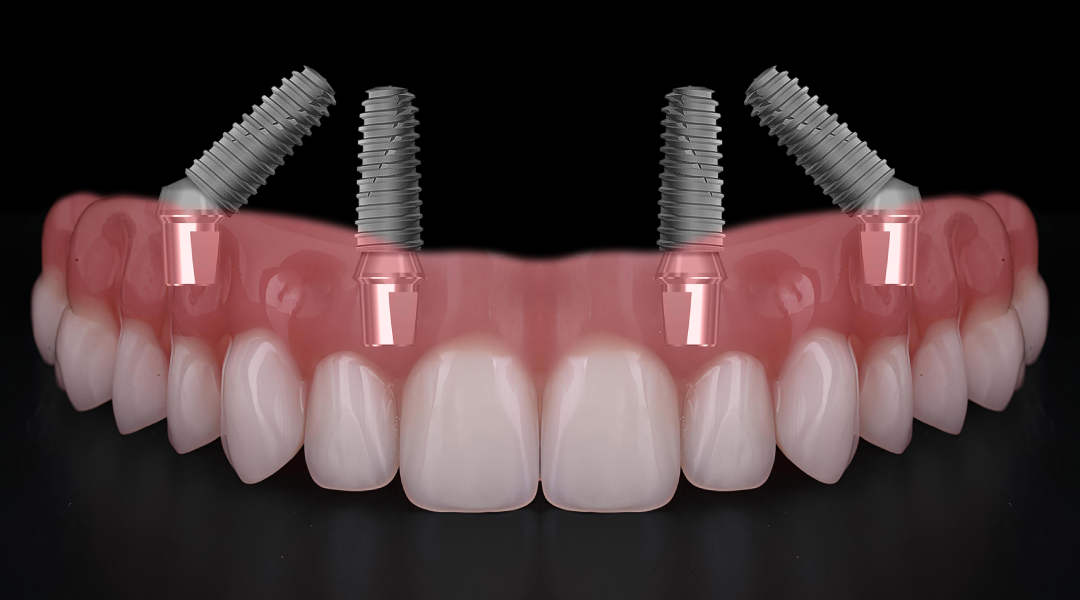 All-On-Four Dentures: Everything You Need to Know