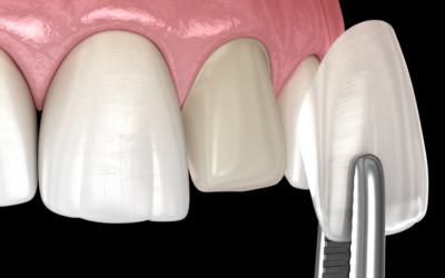 Dental Veneers: The Benefits, Procedure, and the Results