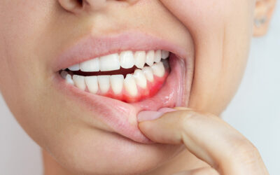 Bleeding Gums When Is it an Emergency and How to Stop It