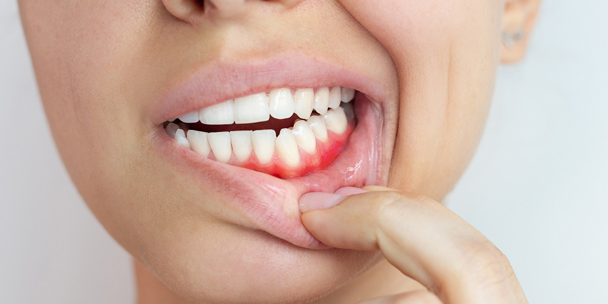 bleeding-gums
