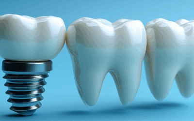 Dental Implants: Do They Feel Different Than Your Natural Teeth?