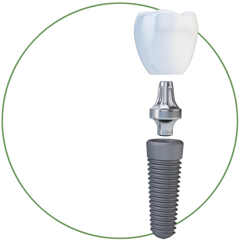 3 parts dental implant