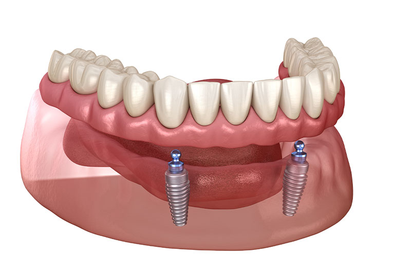 Removable dentures