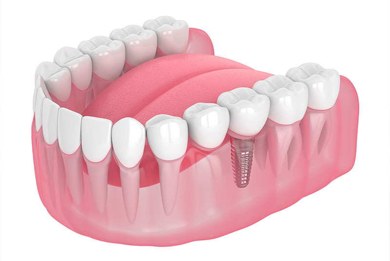 Dental Implant