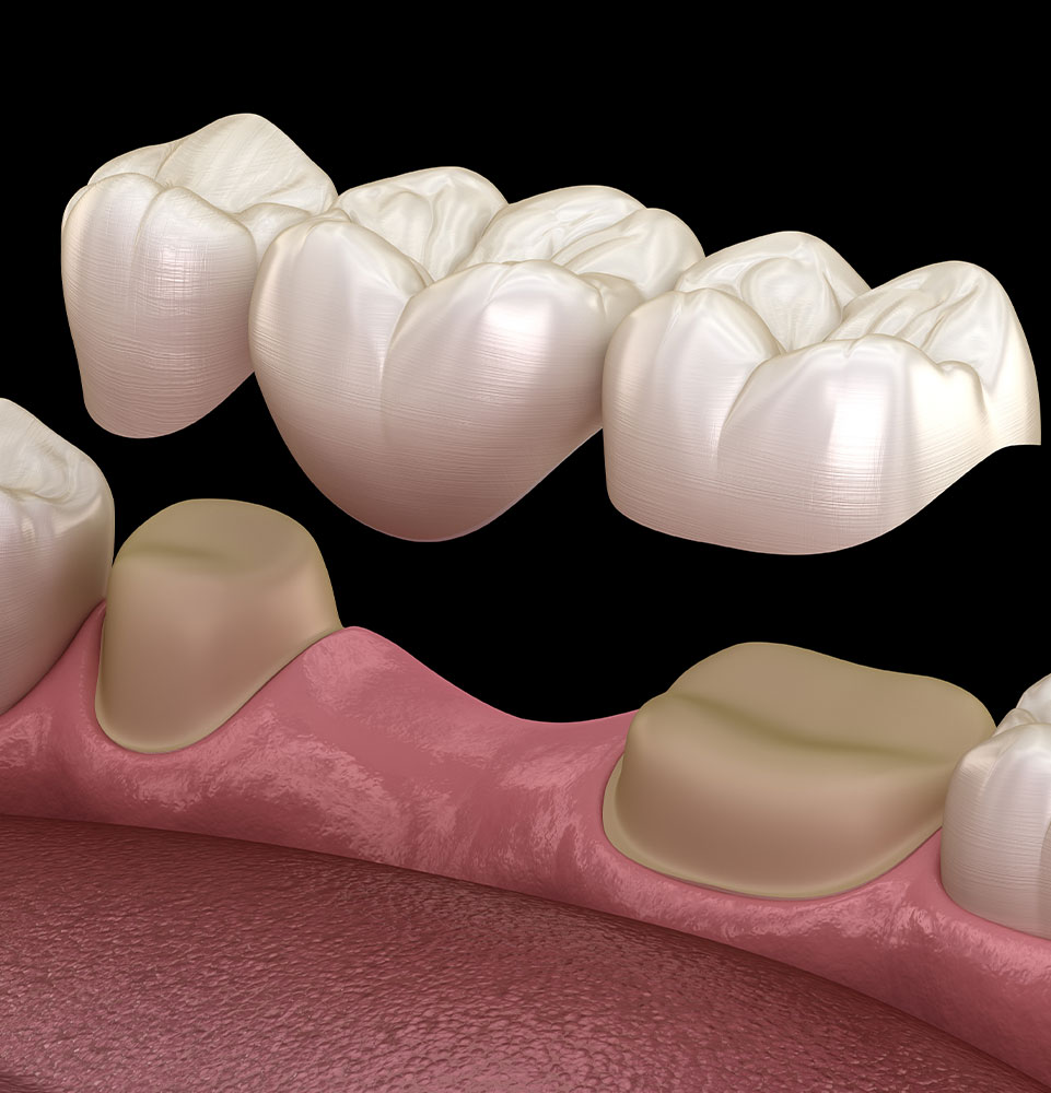 Dental Bridge