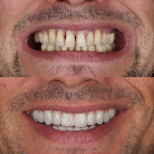 Dental Implants