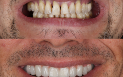 Why Dental Implants Are the Closest Thing to Natural Teeth