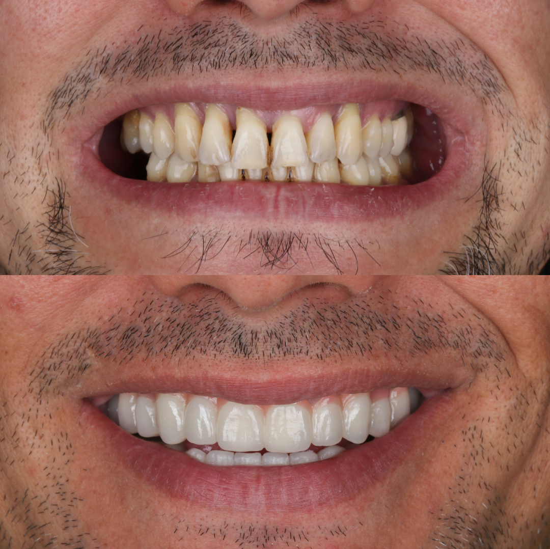 Dental Implants