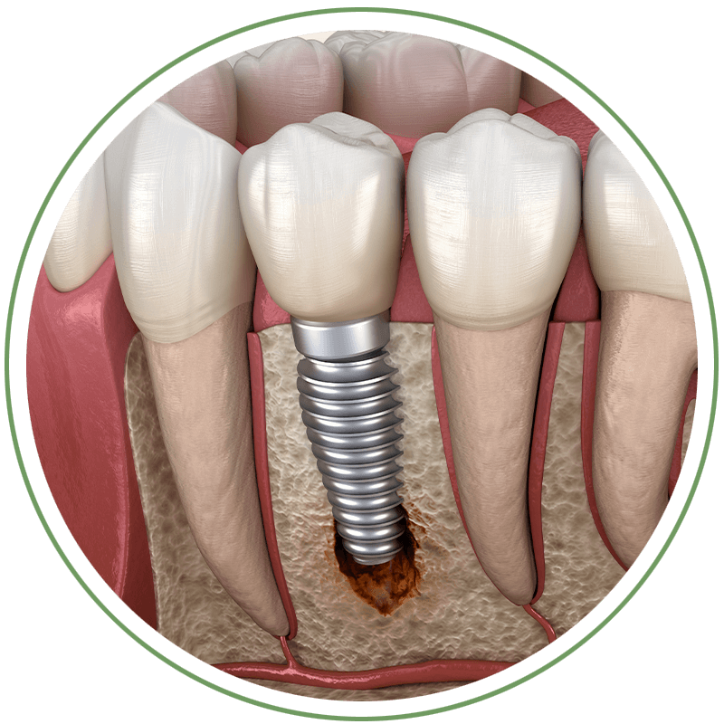 Peri-Implantitis