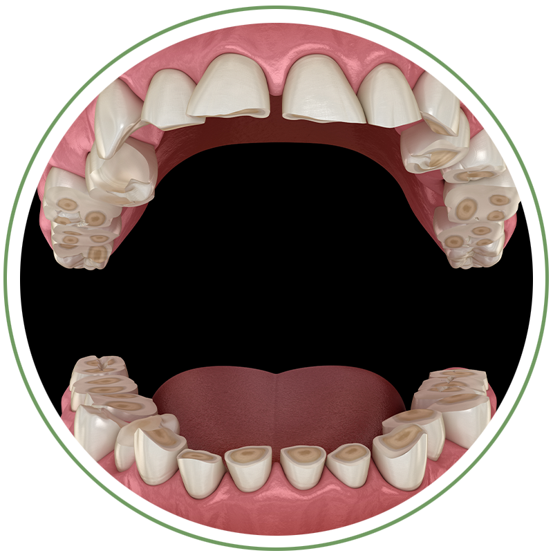 Bruxism