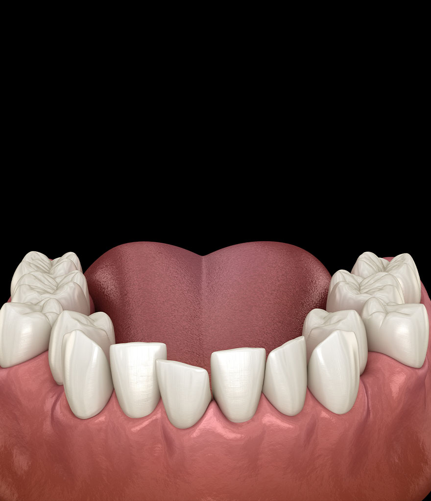 Misaligned teeth