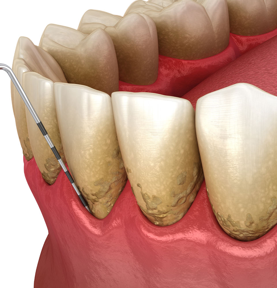 Periodontitis