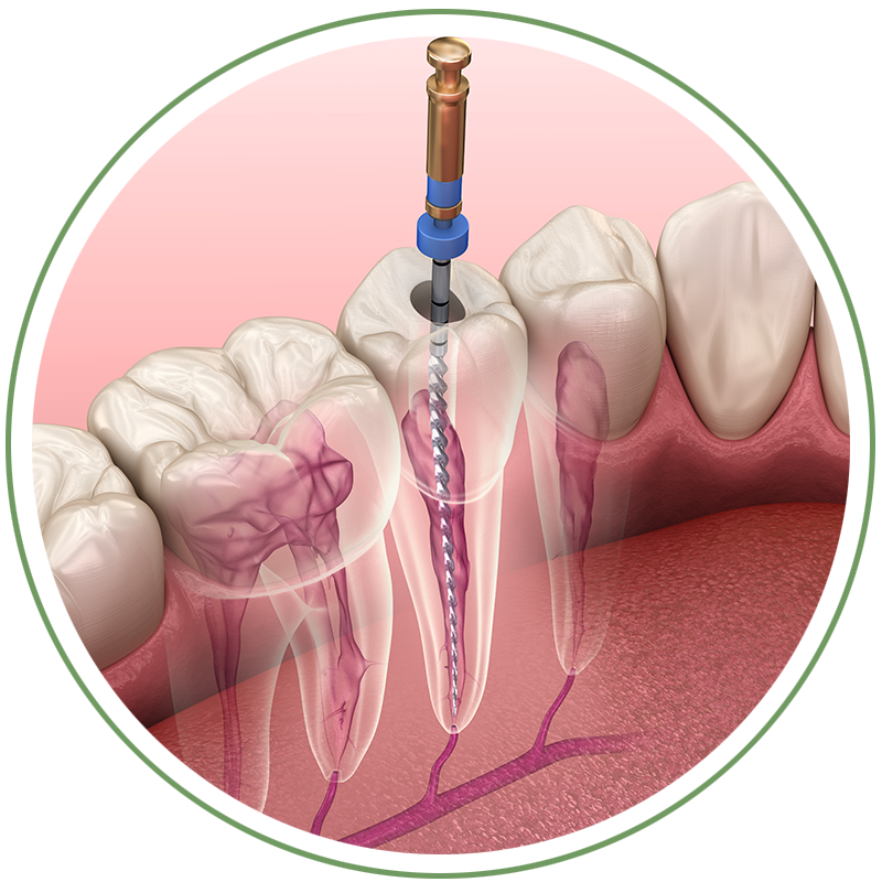 Root canal