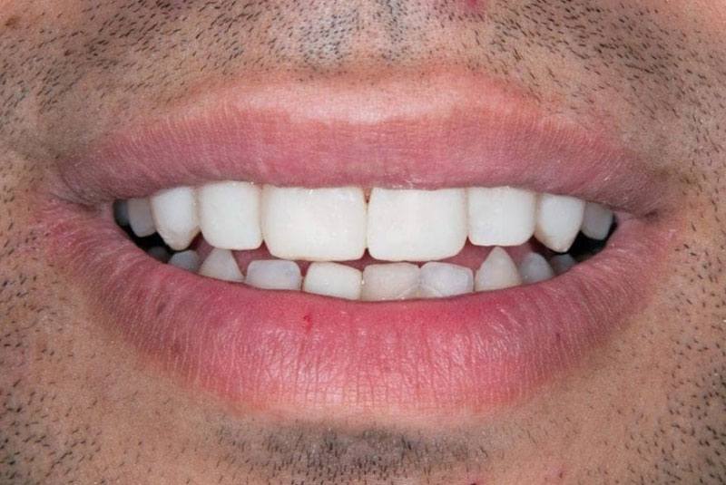 after veneers 2