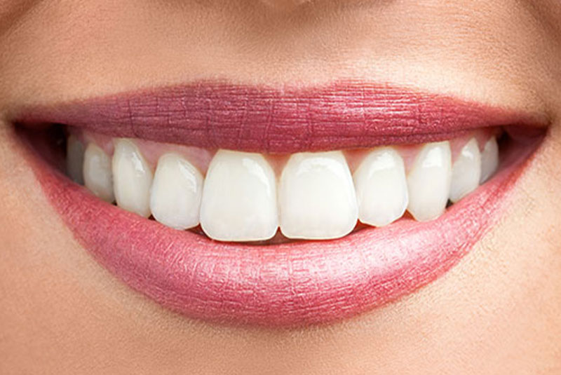 whitening after case 1