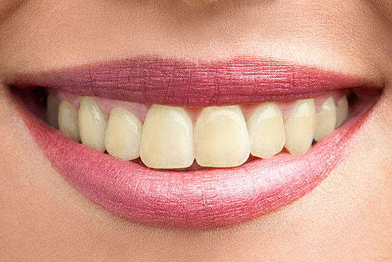 whitening before case 1