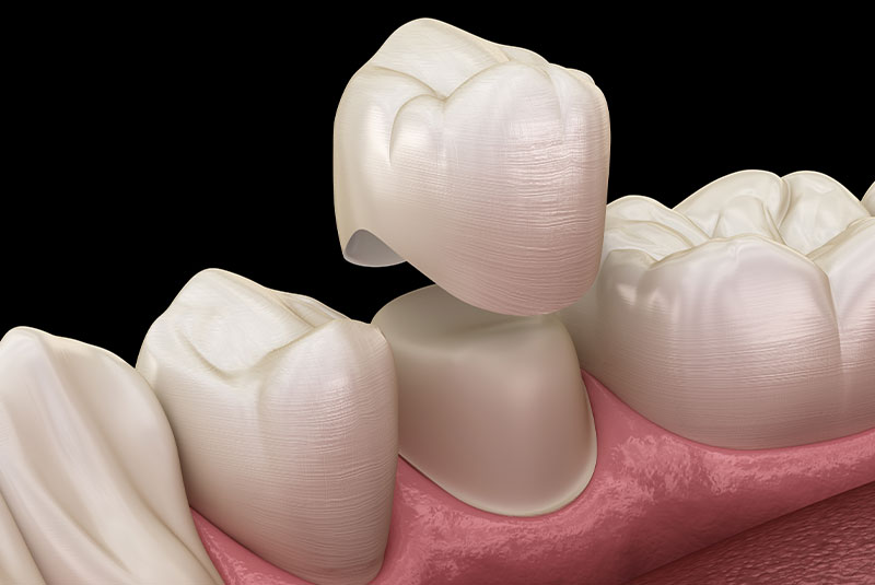 Dental Crowns