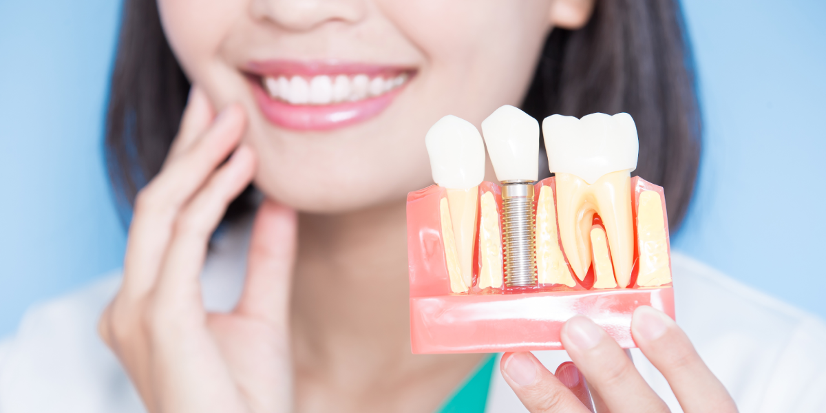 dental implants